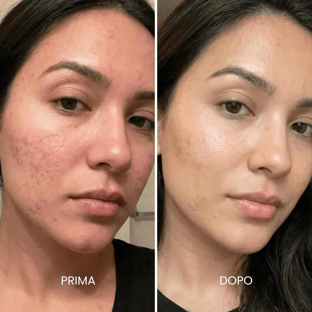 Stick Clinico per il Trattamento delle Cicatrici da Acne
