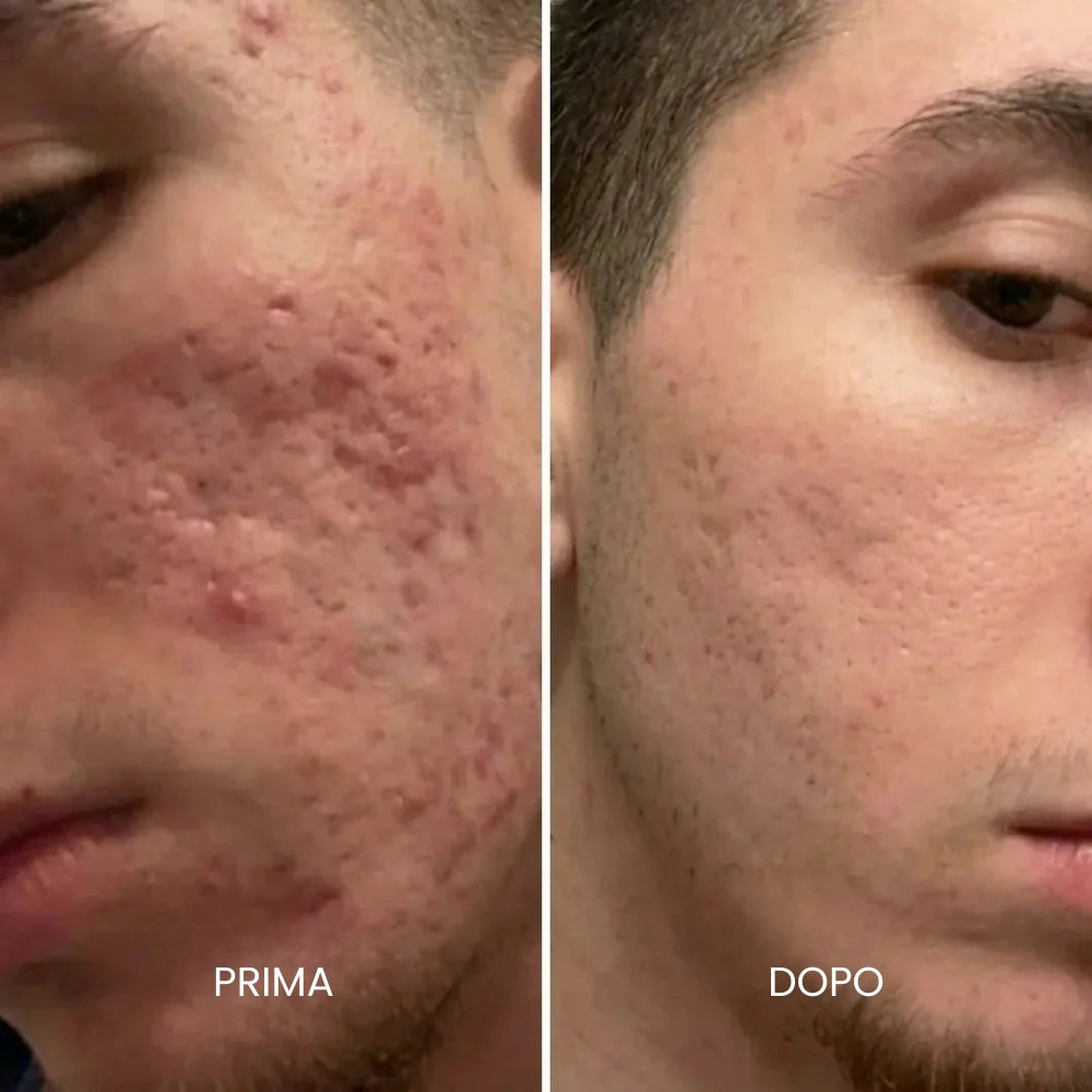 Stick Clinico per il Trattamento delle Cicatrici da Acne